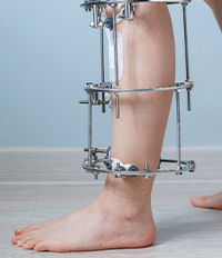 External Fixation